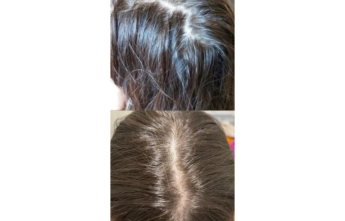 Восстановление густоты волос отзывы. Выпадение волос во время беременности.